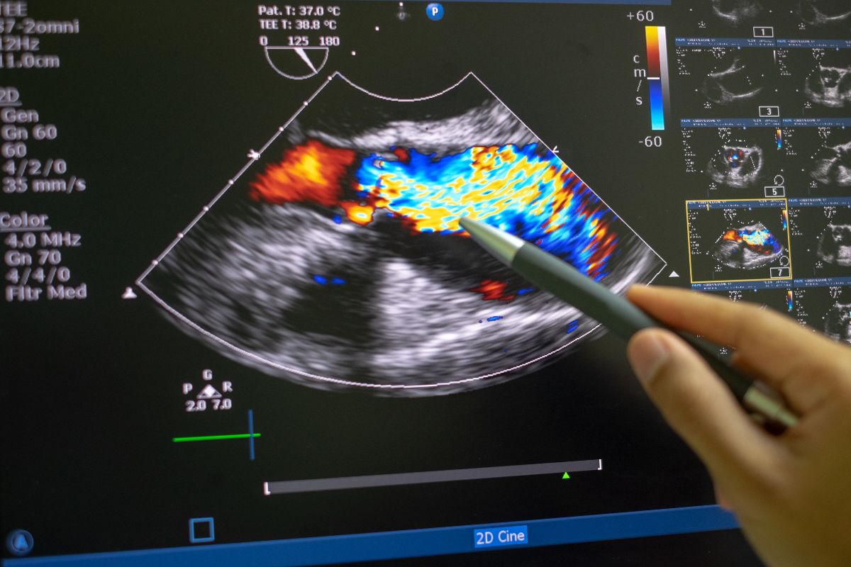 qué es una ecografía Doppler