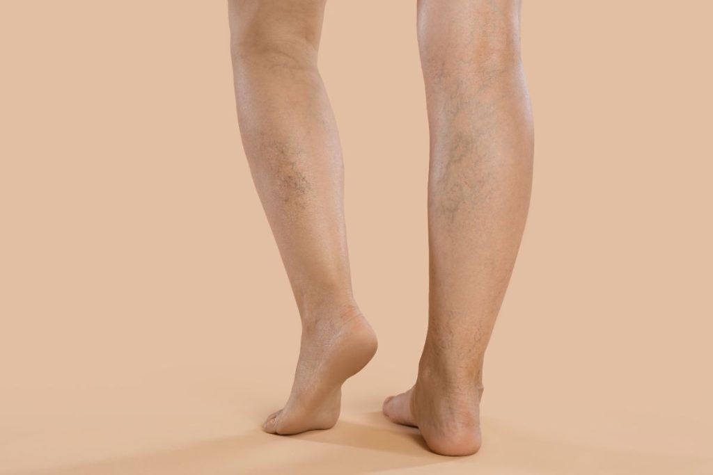 varices asintomáticas tratarlas o vigilarlas