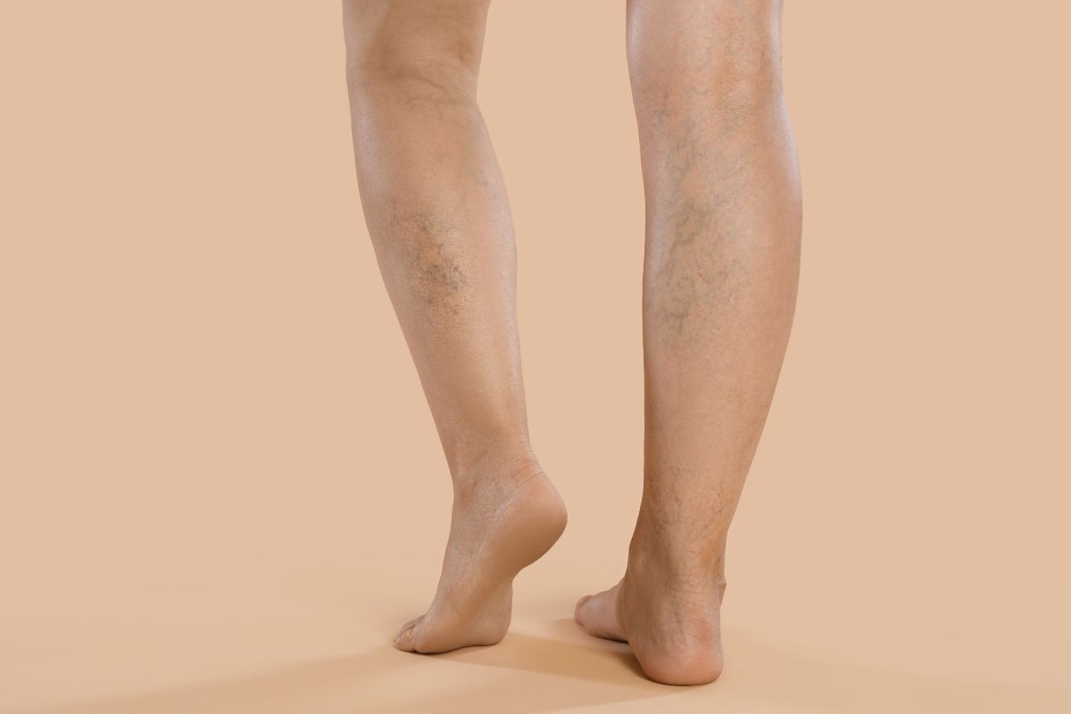 varices asintomáticas tratarlas o vigilarlas
